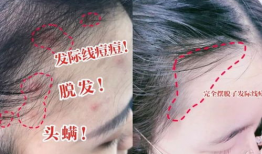 明星头皮,揭秘明星秀发背后的护发秘诀
