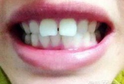 牙齿正畸前后对比图片,见证美丽笑容的神奇之旅